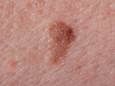 نصائح عن سرطان الجلد