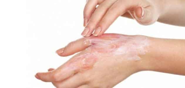 علاج الأكزيما من قبل أطباء الجلد علاج الأكزيما من قبل أطباء الجلد