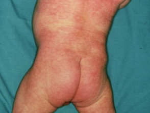 مرض متلازمة كورنيليا عند الاطفال