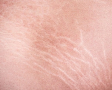 ظهور خطوط بيضاء على الجلد