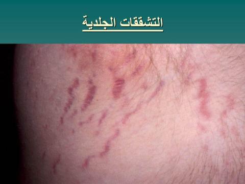 التشققات الجلدية