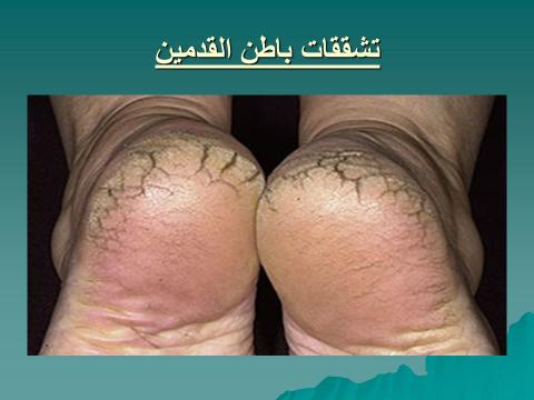 تشققات باطن القدمين