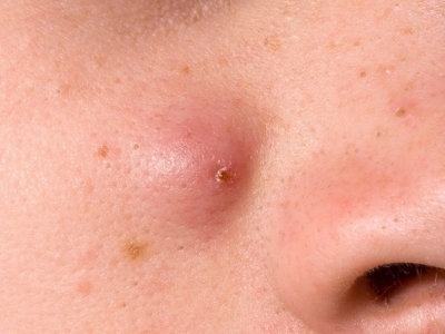 لدي كتلة صغيرة مؤلمة تحت جلد وجهي..هل لها تفسير طبي؟