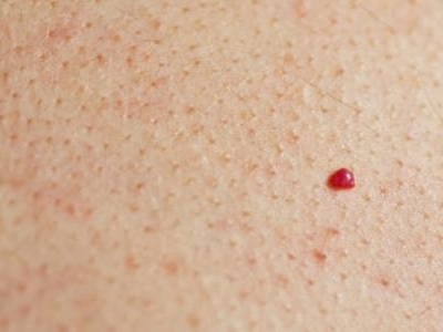 هل البقع الحمراء الصغيرة على الجلد مرض أم حالة عادية؟