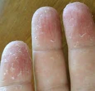 ما علاج تشققات الأصابع؟