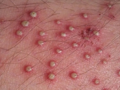 التهاب البكتيريا في الجلد.. أسبابه وعلاجه