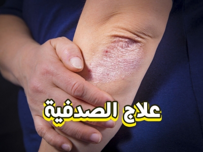 حقيقة علاج مرض الصدفية نهائياً - الدكتور حسن العماري