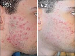 علاج حب الشباب