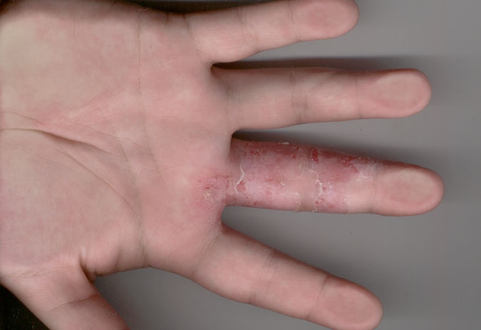 اكزيما اليدين