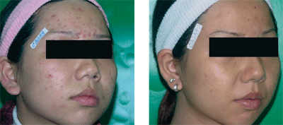 علاج حب الشباب الرواكتين