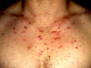 الندبات المرتفعة 