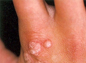 الثآليل الشائعة.