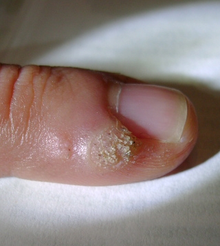 الثأليل الفيروسية على الأصبع