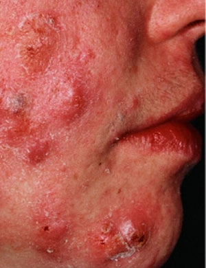 حب الشباب (عقيدات )