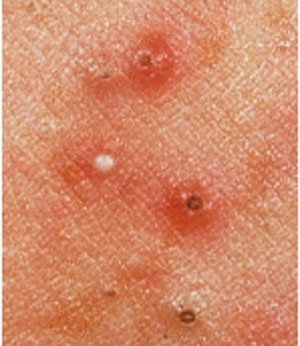  حب الشباب (رؤوس  سوداء و رؤوس بيضاء)