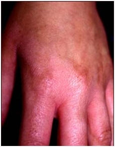 حساسية تلامسية من أستخدام بعض مواد التنظيف