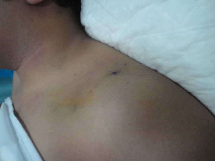 صورة لورم شحمي بعد علاجه بالطريقة الجراحية 