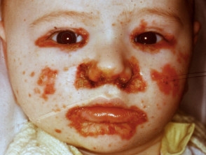 التهاب الجلد الوريدي المعوي