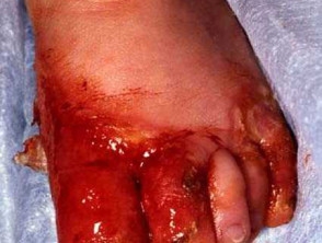 التهاب الجلد الوريدي المعوي