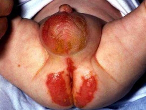 التهاب الجلد الوريدي المعوي