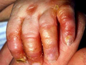 التهاب الجلد الوريدي المعوي